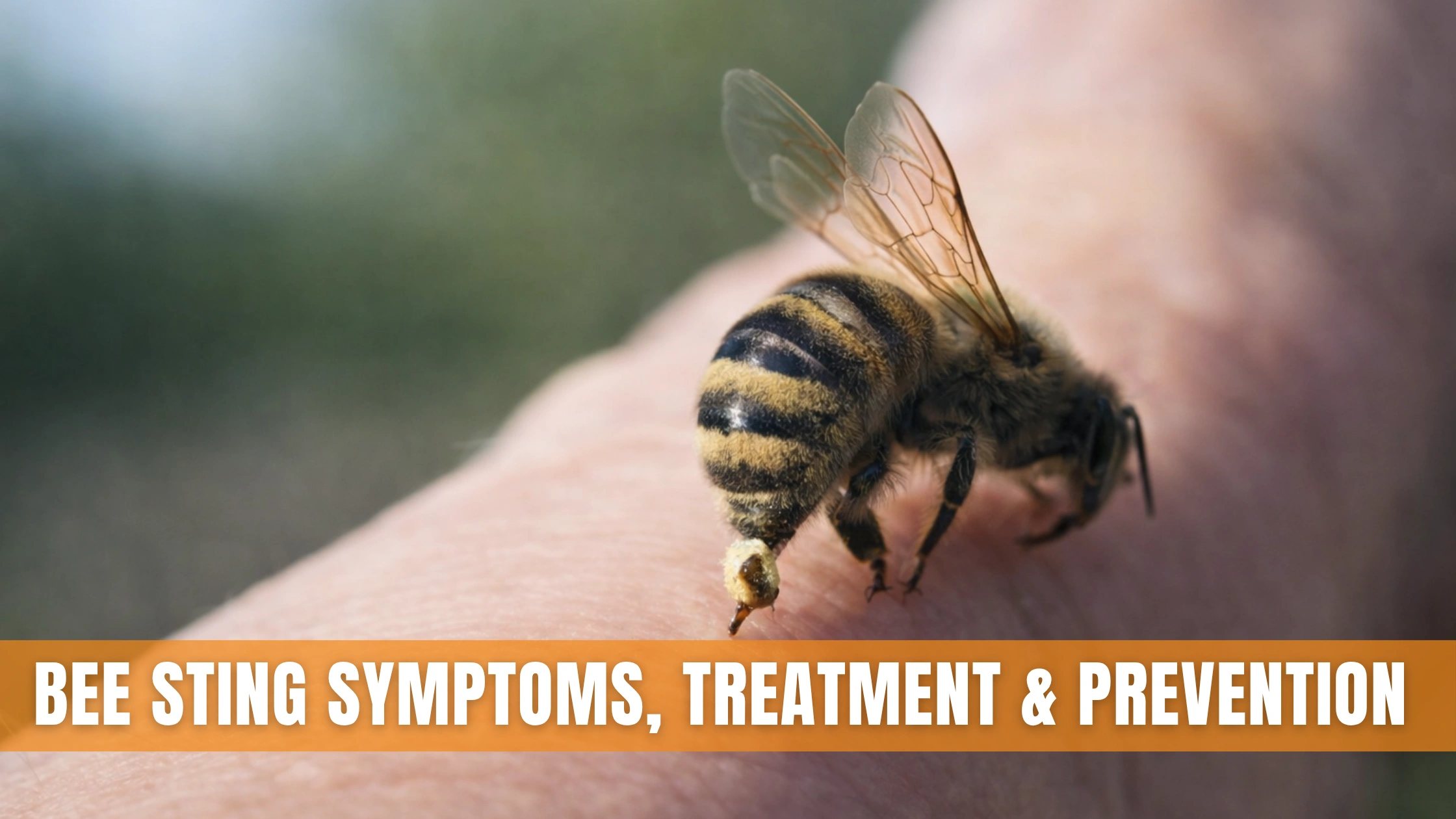 Bee Sting Symptoms, Treatment & Prevention