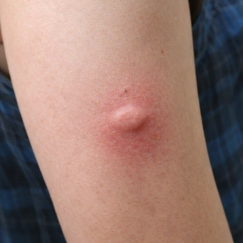 How Does Red Back Spider Bite Looks Like