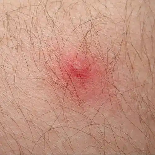 What Does a Tick Bite Look Like