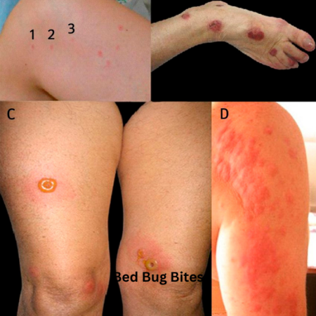 bed bug bite