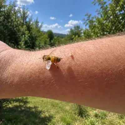 Bee Sting